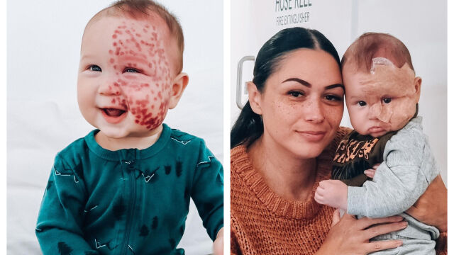 Снимка: Майка е наречена „чудовище“ заради решението й да премахне с лазер родилно петно на бебето си