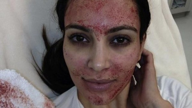 Снимка: Ким Кардашиян се подмладява със собствената си кръв