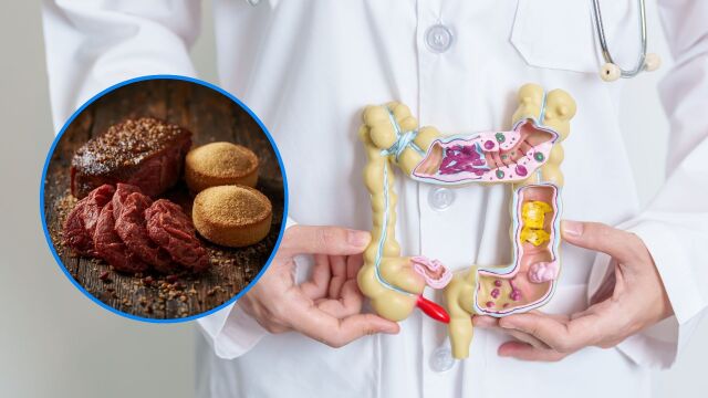 Снимка: Ракът на дебелото черво при млади хора може да е свързан с диетата