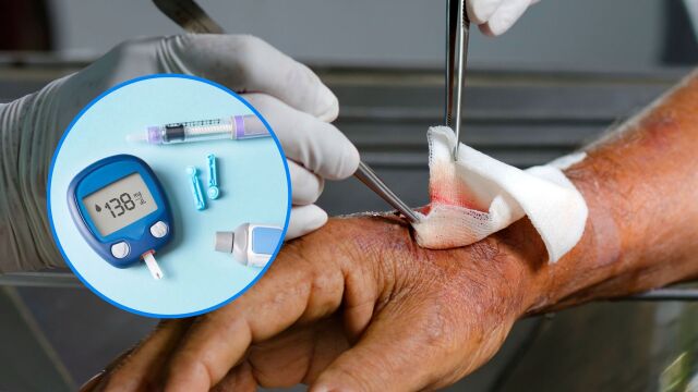 Снимка: Трудно зарастващи рани при диабет: Каква е ролята на имунната система