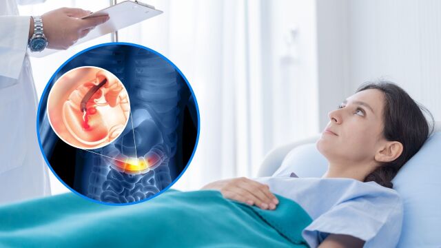 Снимка: Възстановяване след колоноскопия: Как да се почувствате добре по-бързо