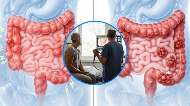 Снимка: Синдром на раздразненото черво или рак: Как да разпознаете симптомите
