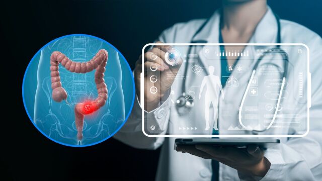 Снимка: Нов тест открива риска от рак на дебелото черво с 99% точност
