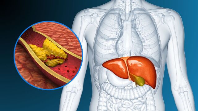 Снимка: Откриват нов начина за лечение на холестерол и омазнен черен дроб