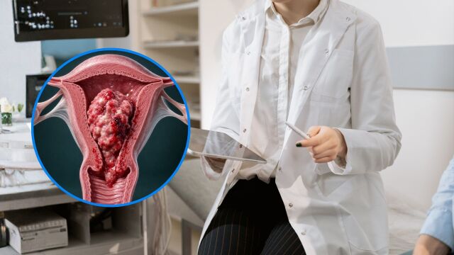 Снимка: Кои жени са в най-висок риск от рак на матката