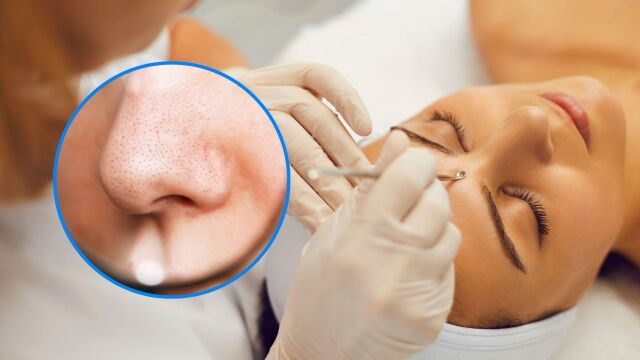 Снимка: Черни точки по лицето: Как да ги премахнете безопасно и лесно у дома
