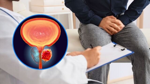 Снимка: Рак на простатата: Кой вид е най-агресивен и каква е преживяемостта