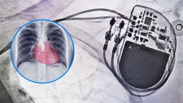 Снимка: Видове пейсмейкъри: Кой вариант е подходящ за вашето сърдечно здраве?