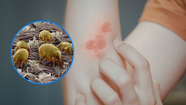 Снимка: 5 симптома, че имате алергия към прах