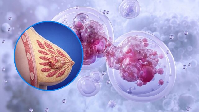 Снимка: Има ли връзка между рак на гърдата и рак на яйчниците?