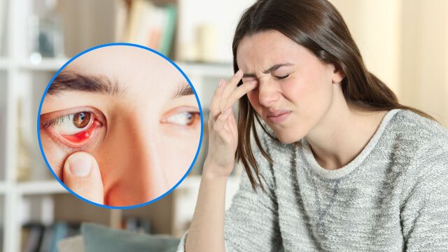 Снимка: Защо вътрешният ечемик на окото може да е опасен и как да го лекувате