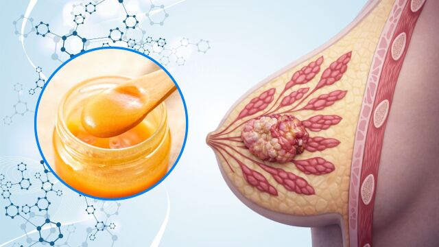 Снимка: Мед от Манука при рак на гърдата: Намалява с 84% растежа на тумора