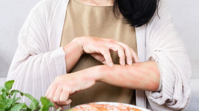 Снимка: Хронична уртикария: 26 000 души в България страдат от заболяването