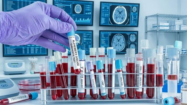 Снимка: Кръвен тест за Алцхаймер получaва първо одобрение в Европа