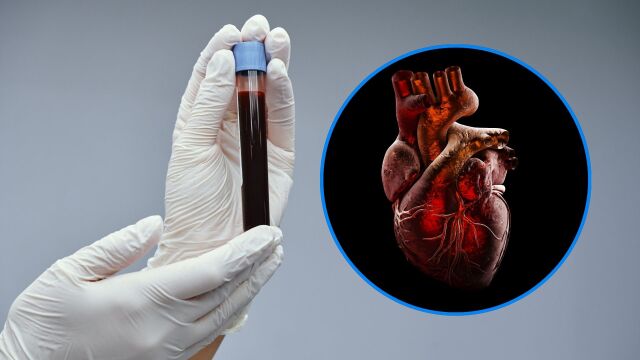 Снимка: Кръвният тест, който предсказва инфаркт: Оказва се, че не е холестеролът