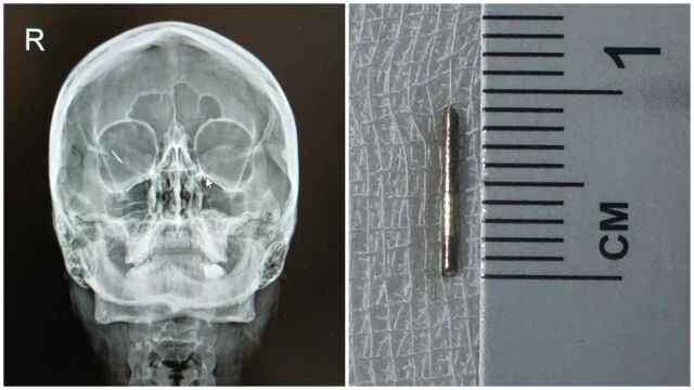 Спешна операция спаси зрението на млада жена с 10-милиметрова шнола в окото