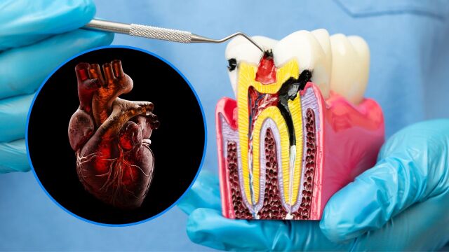 Снимка: Лечение на зъбен канал намалява риска от сърдечни заболявания и диабет