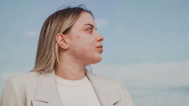 Снимка: #ЗаедноСме: Емпатия и подкрепа в кампанията на BIODERMA в борбата срещу акнето