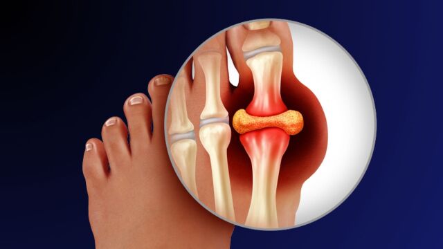 Снимка: Стадии на подагра: Какви са първите симптоми и как да ги контролираме