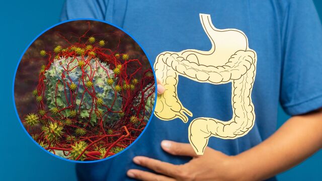 Снимка: Рак на дебелото черво: GLP-1 лекарствата намаляват смъртността с над 50%