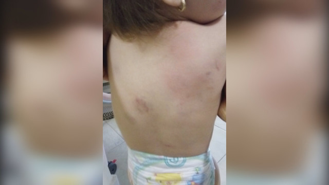 Снимка: Проверяват детска градина в Бургас заради нахапано дете