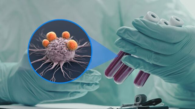 Снимка: Кръвен тест за над 50 вида рак обещава по-ранна диагностика