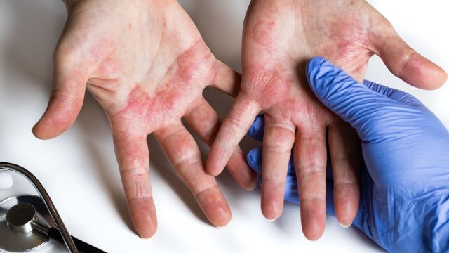 Снимка: 400 хил. деца се борят с атопичен дерматит: Къде да се прегледате безплатно