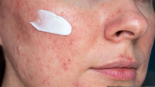 Снимка: Сода за хляб върху лицето може да доведе до трайни увреждания