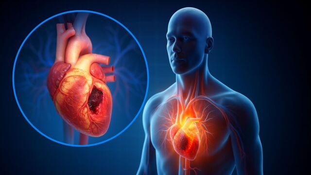 Снимка: Ново лечение намалява риска от сърдечна недостатъчност след инфаркт