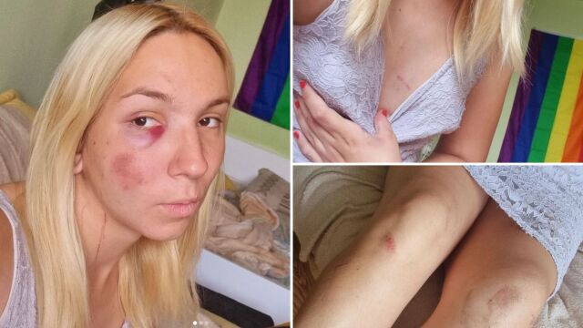 Снимка: Емили пак е насинена – транс момичето отново пострада на пътя (СНИМКИ)