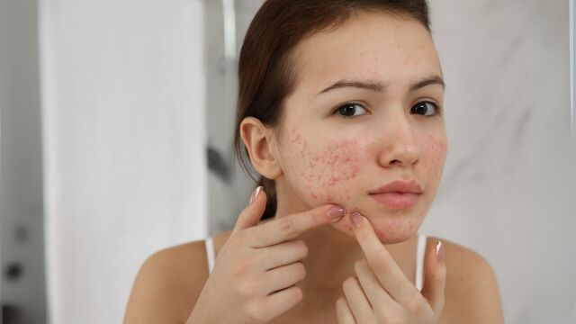 Снимка: Акне: BIODERMA отново с безплатни прегледи и онлайн консултации