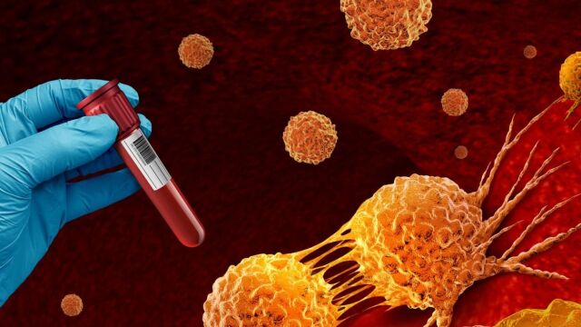 Снимка: AI изображения разкриват симптоми на рядък вид рак на кръвта