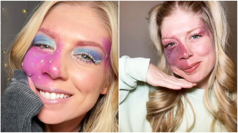 От подигравки до милиони последователи: Как едно момиче превърна родилния си белег в сила