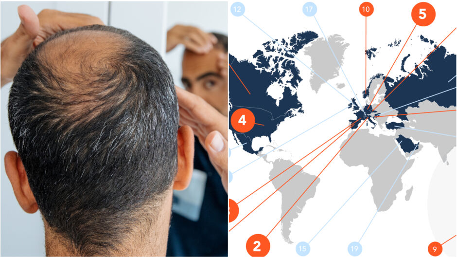 Кои са страните с най-плешивите мъже в света (СНИМКИ + ВИДЕО)